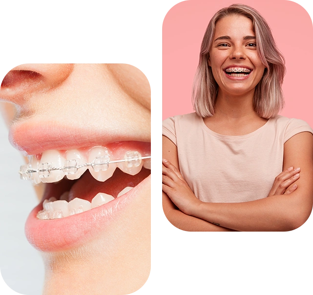 How Much Clear Braces Cost London ?