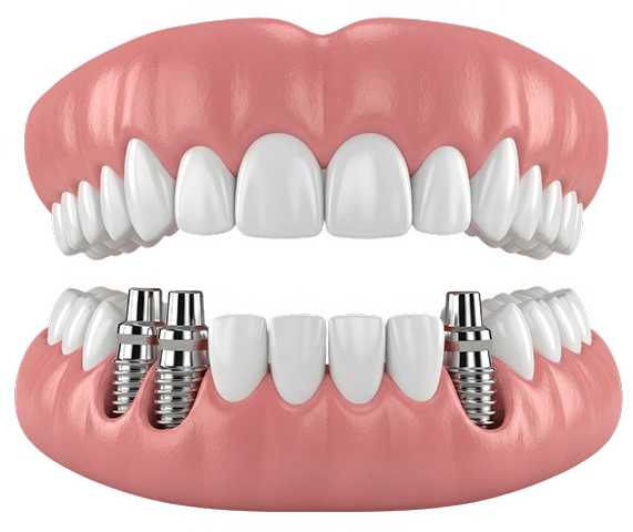 Dental Implants Treatment in London at Chatfield Dental Braces