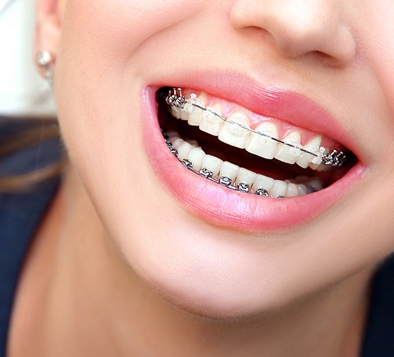 how much do Braces cost in Chatfield Clear braces London?