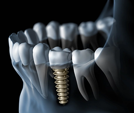 Best Dental Implants in London