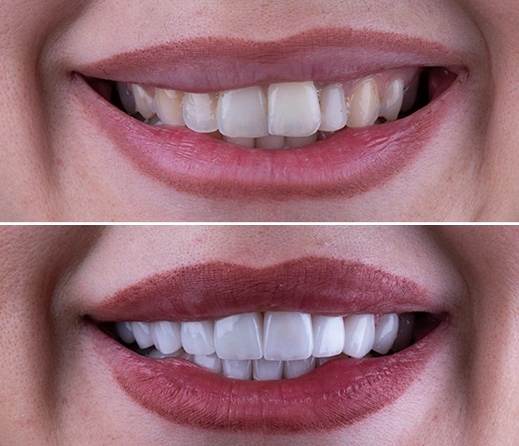 Dental Veneers Before and After Image