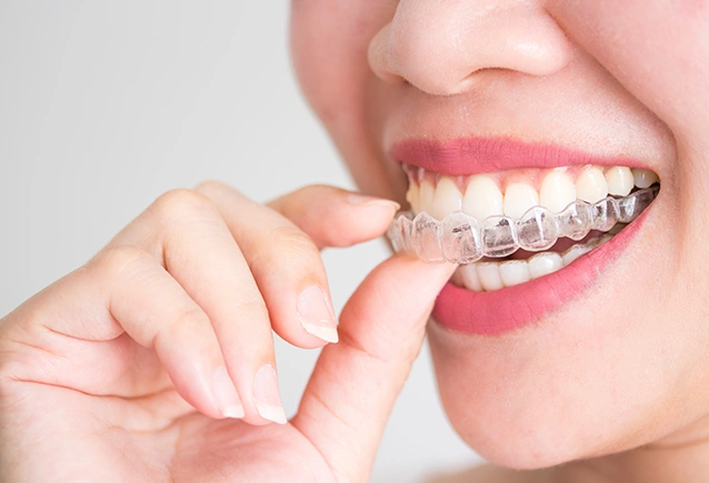 Invisalign clear aligner treatment in Battersea, London