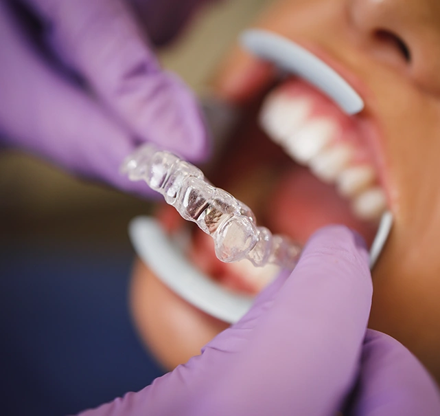 Invisalign Lite treatment in London - Chatfield Dental Braces
