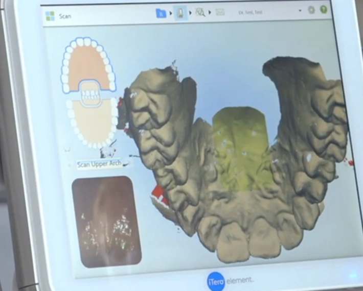Invisalign Treatment price in Chatfield Dental Braces