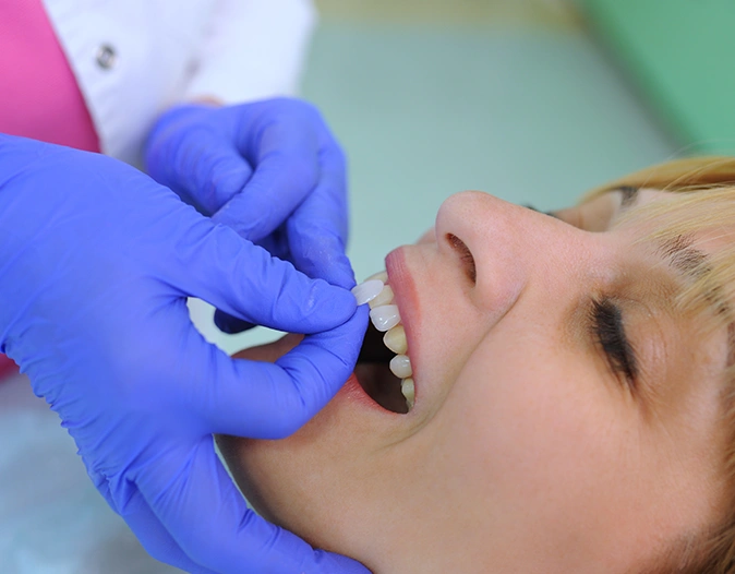Dental Veneers Treatment Cost in London