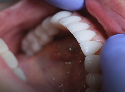 Lumineer Veneer Image - Chatfield Dental Braces