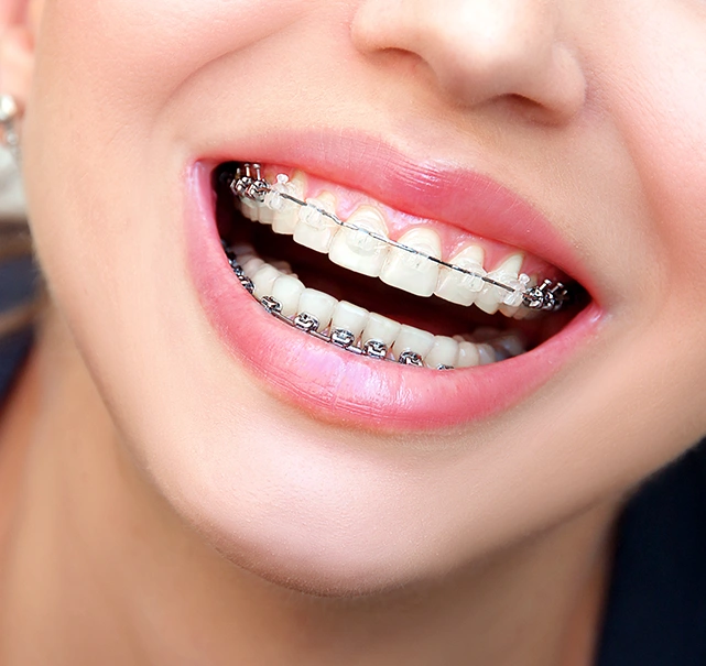 Misaligned teeth straightened with braces at Chatfield Dental Clinic
