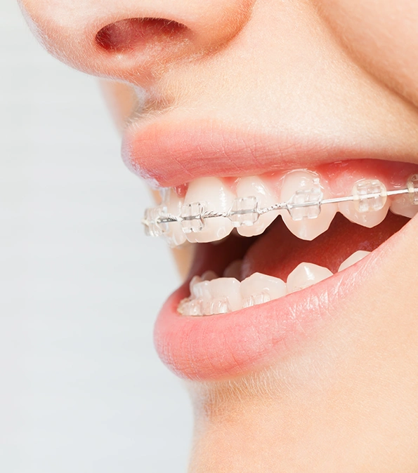 Orthodontic Treatment in clear Braces London