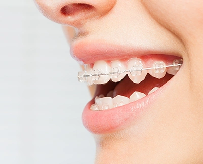 Orthodontics Six-Month Braces treatment at Chatfield Dental Braces