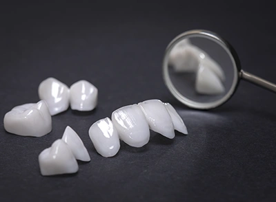 Porcelain Veneers Image - Chatfield Dental Braces