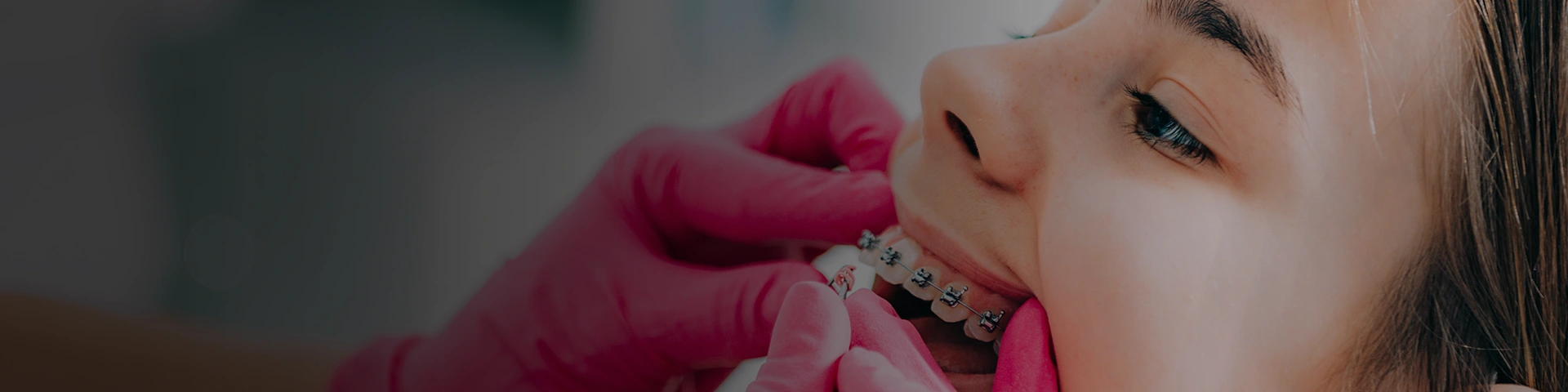 Six Month Braces Banner Image At Chatfield Dental Clinic