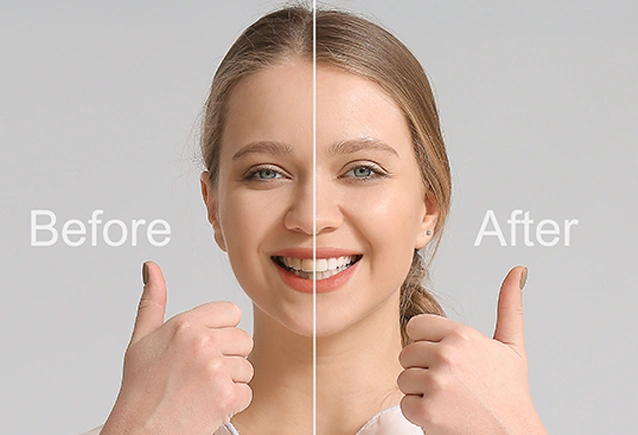 Smile Makeover London before and after image