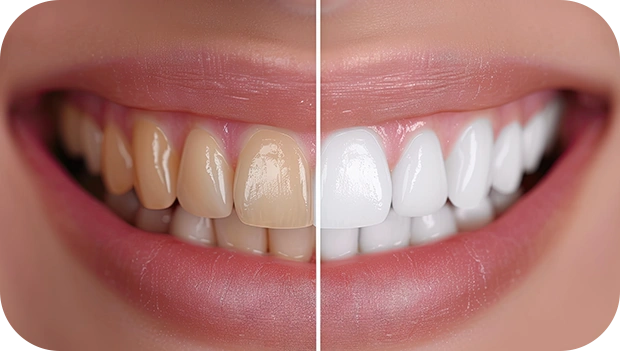 Teeth Whitening Before After