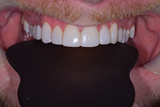 Bonding and Ceramic Crown image 04