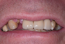 Composite Bonding London Image 1