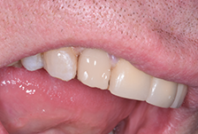 Composite Bonding London Image 2
