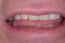 Composite Bonding London Image 3