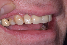 Composite Bonding London Image 4