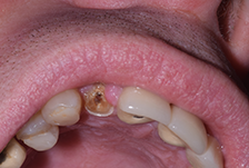 Composite Bonding London Image 5