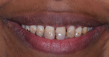 Composite Bonding London Image 6
