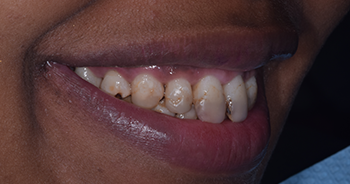 Composite Bonding London Image 7