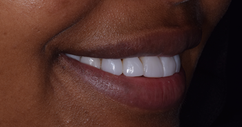 Composite Bonding London Image 10