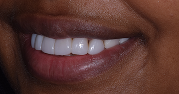 Composite Bonding London Image 11