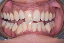 Invisalign Dentist London Image 03