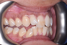 Invisalign Dentist London Image 04