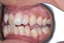 Invisalign Dentist London Image 05