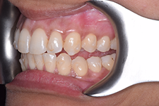 Invisalign Dentist London Post Image 08
