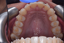 Invisalign Dentist London Post Image 09