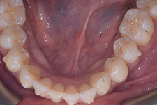 Invisalign Dentist London Post Image 10