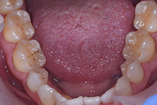 Invisalign Dentist London Pre Image 12