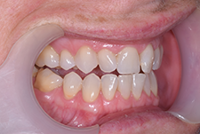 Invisalign Dentist London Pre Image 14