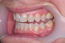 Invisalign Dentist London Pre Image 15