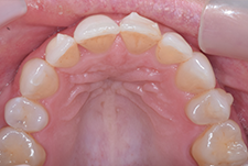 Invisalign Dentist London Post Image 16