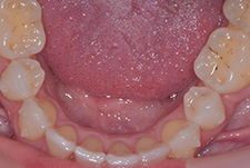 Invisalign Dentist London Post Image 17