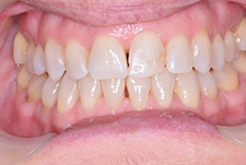 Invisalign Dentist London Post Image 18