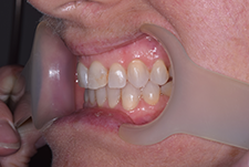 Invisalign Dentist London Post Image 20