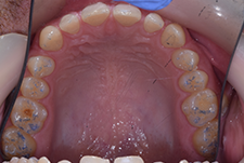Invisalign Dentist London Pre Image 21