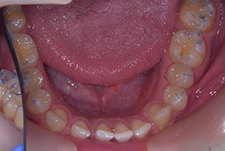 Invisalign Dentist London Pre Image 22