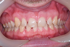 Invisalign Dentist London Post Image 23