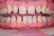Invisalign Dentist London Post Image 24
