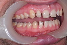 Invisalign Dentist London Post Image 25