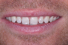 Invisalign Dentist London Post Image 27