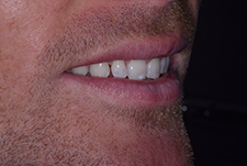 Invisalign Dentist London Post Image 28