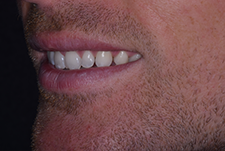 Invisalign Dentist London Image 29
