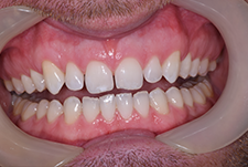 Invisalign Dentist London Image 30