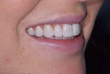 Porcelain Veneers Treatment image 02